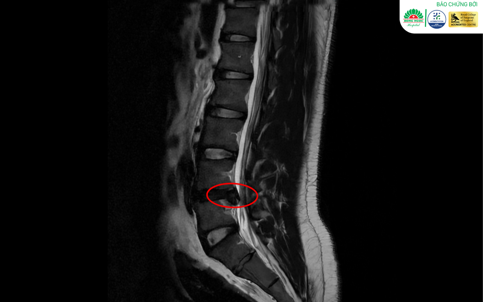 thoát vị đĩa đệm cột sống thắt lưng 