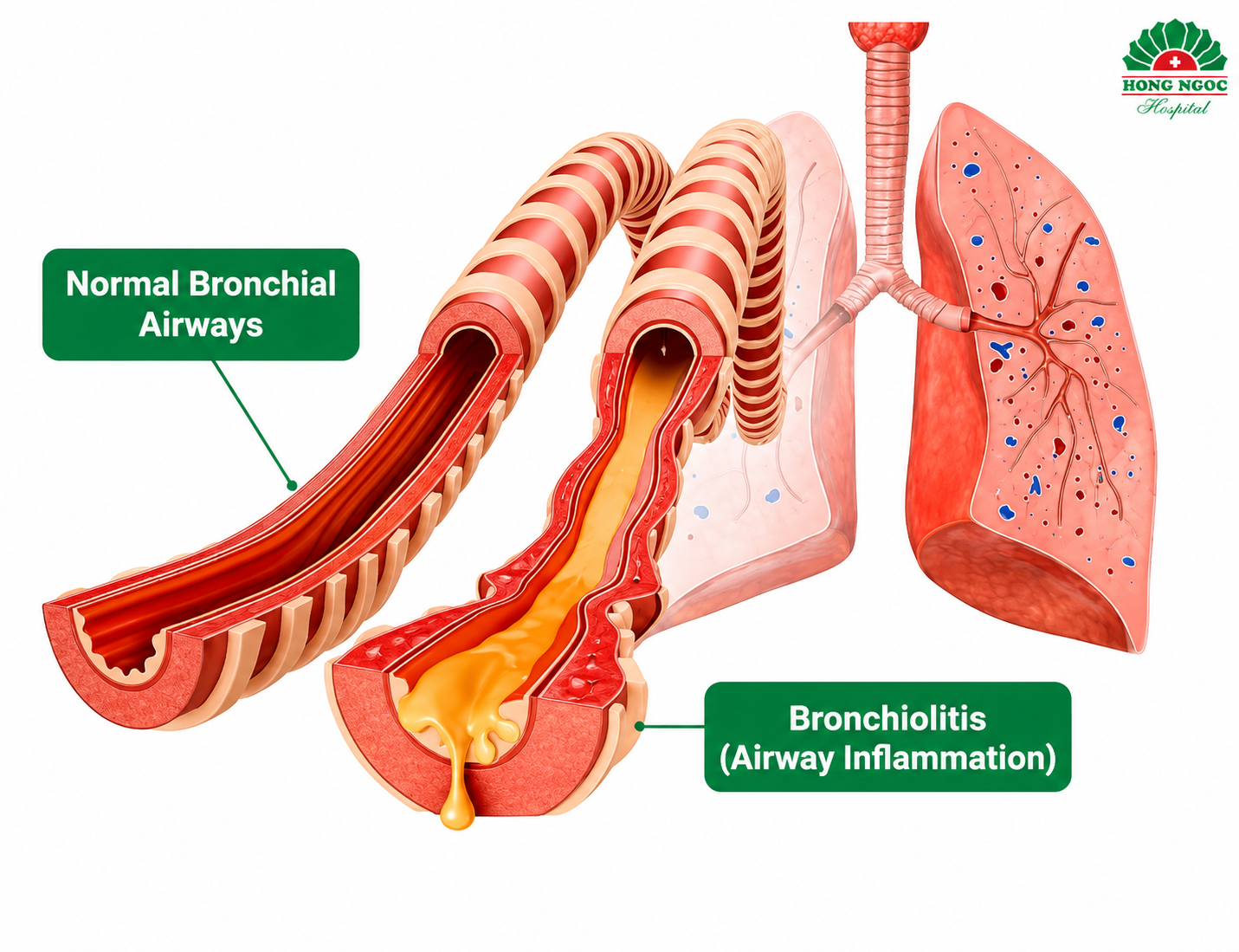 Bronchiolitis