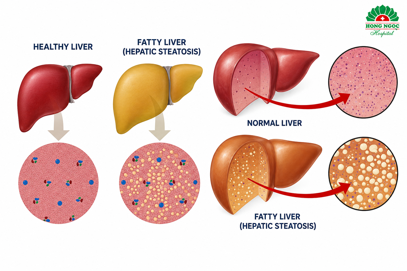 People with a high BMI are more likely to accumulate fat in the liver.