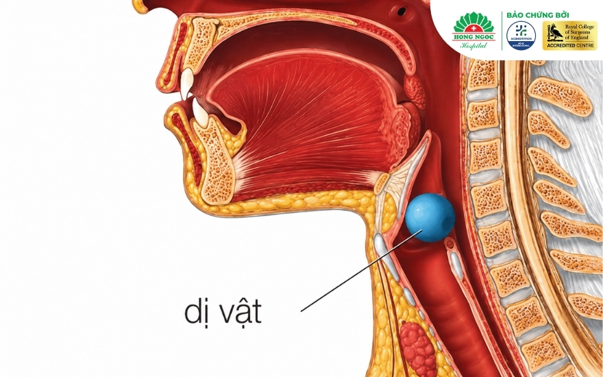 Hóc dị vật đường thở có thể đe dọa trực tiếp đến tình mạng bệnh nhân chỉ trong vài phút