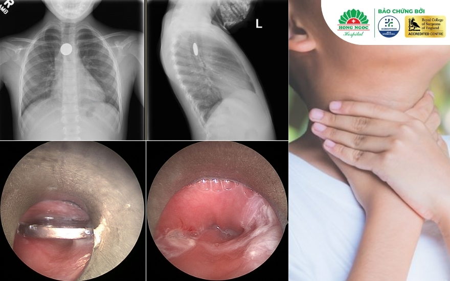 Hóc dị vật đường thở có thể xảy ra ở bất kỳ độ tuổi nào