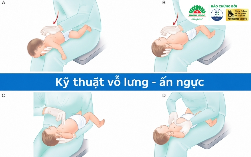 Kỹ thuật vỗ lưng - ấn ngực sơ cứu&nbsp; hóc dị vật đường thở áp dụng cho trẻ dưới 1 tuổi