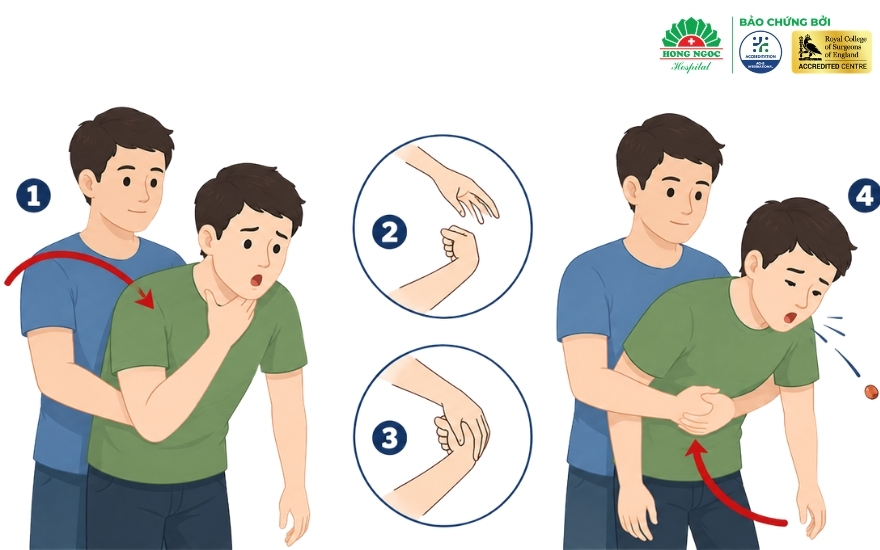 Kỹ thuật Heimlich sơ cứu hóc dị vật đường thở áp dụng cho trẻ trên 1 tuổi và người trưởng thành