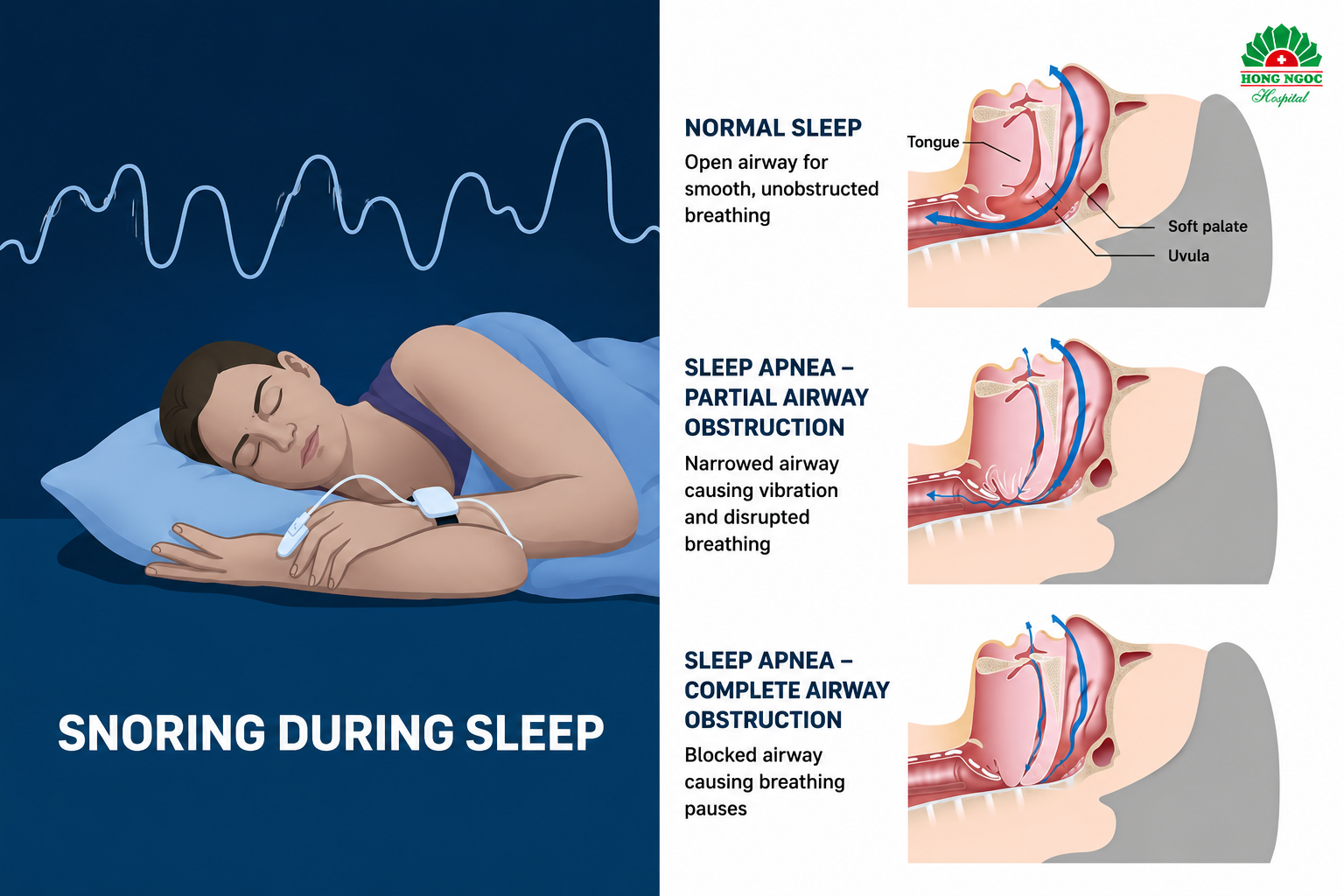 Sleep apnea syndrome