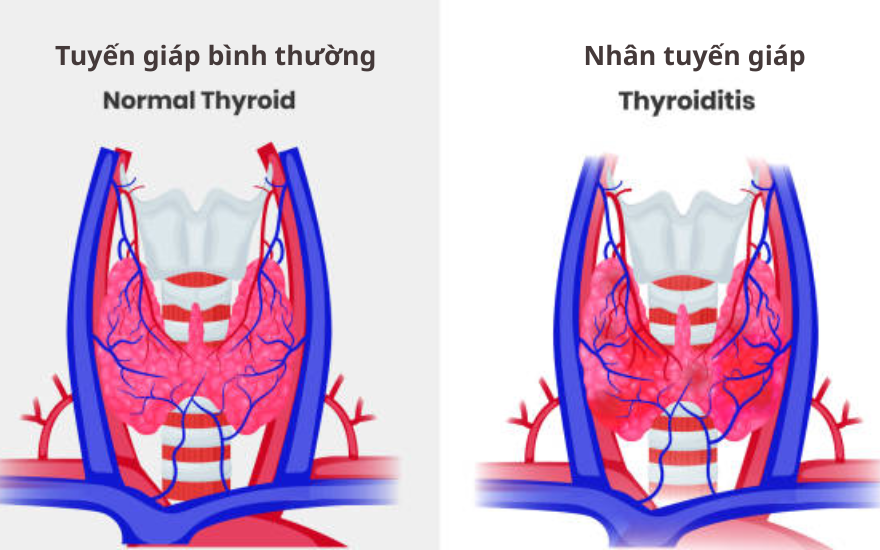 Nguyên nhân gây nhân tuyến giáp