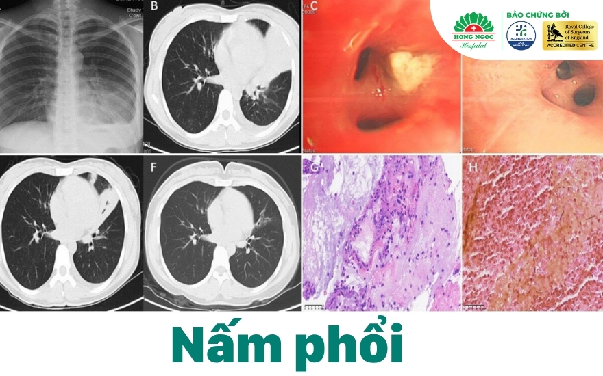 Nấm phổi là tình trạng mô phổi bị tổn thương và viêm nhiễm do các bào tử nấm xâm nhập 