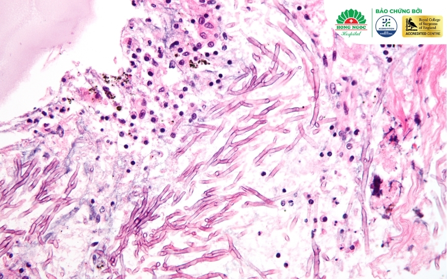 Nấm phổi aspergillus là dạng phổ biến và phức tạp nhất