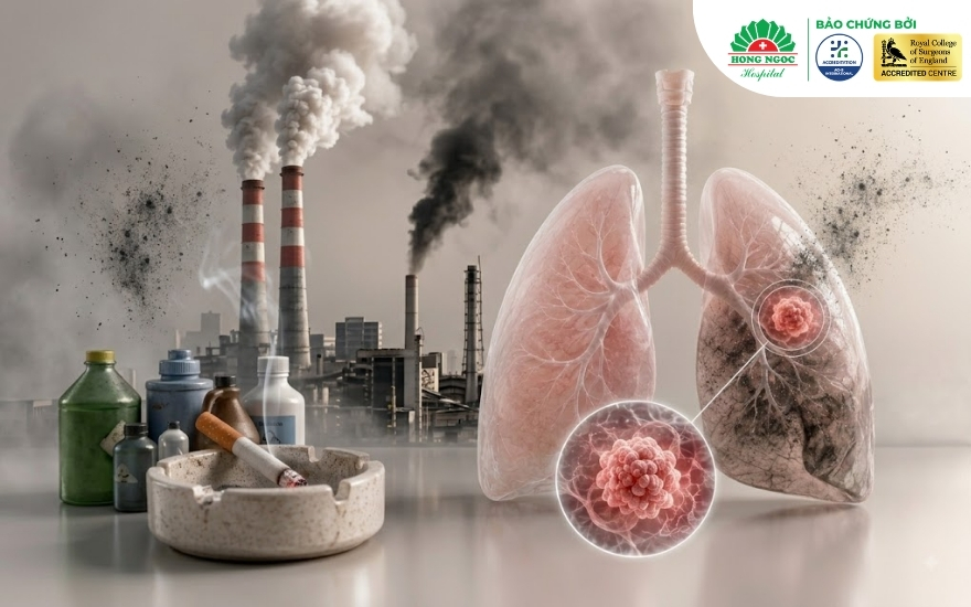 Nốt mờ phổi ác tính có nguy cơ cao ở người có tiền sử hút thuốc hoặc tiếp xúc chất độc hại