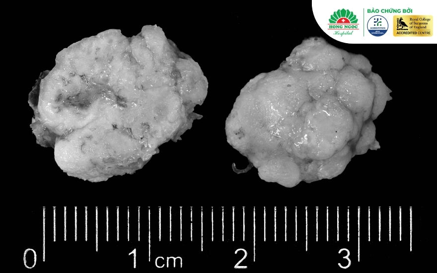 U sụn phổi (Hamartoma) là loại u phổi lành tính phổ biến nhất&nbsp;&nbsp;&nbsp;&nbsp;&nbsp;&nbsp; 