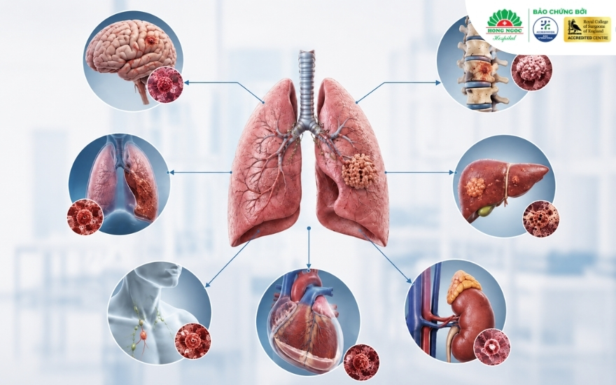 Ung thư phổi thường di căn đến các cơ quan như não, xương, gan, tuyến thượng thận, màng tim….