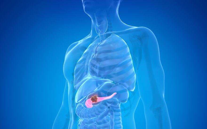Mục tiêu trọng tâm trong điều trị ung thư tụy giai đoạn 1 và 2 là bóc tách và phẫu thuật loại bỏ hoàn toàn khối u.