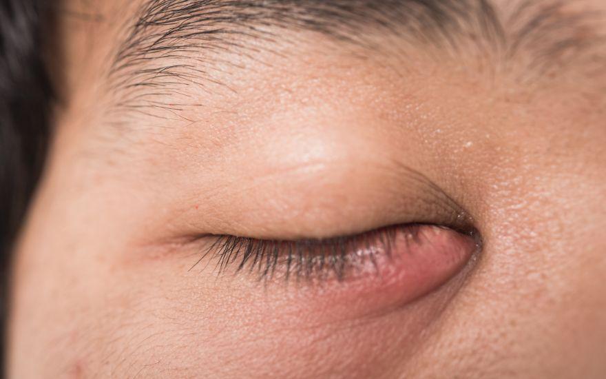 Phân biệt chính xác các loại tổn thương quanh mắt là bước đầu tiên để có hướng xử lý an toàn và hiệu quả.