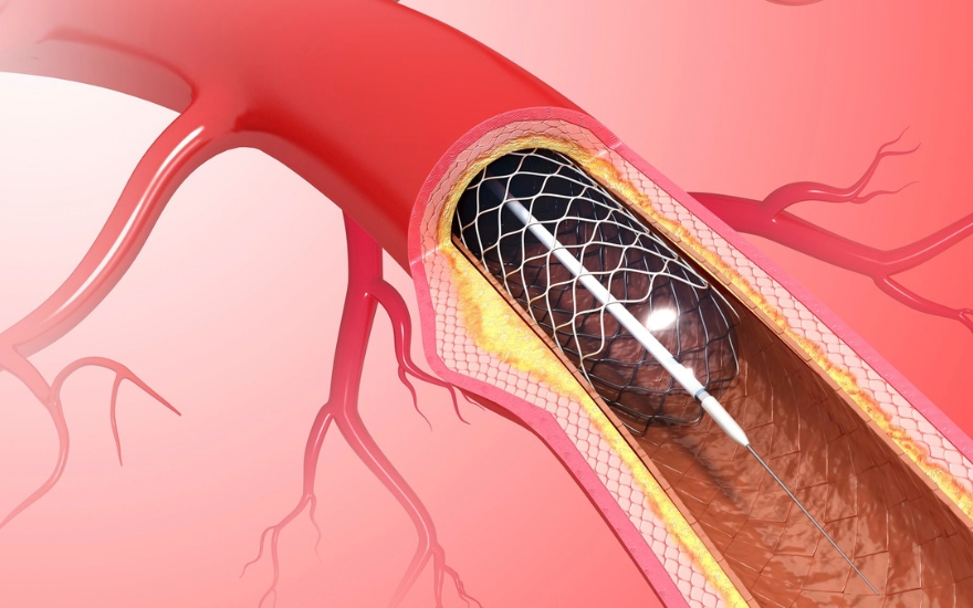 Đặt stent mạch vành là phương pháp phổ biến điều trị tắc động mạch vành 