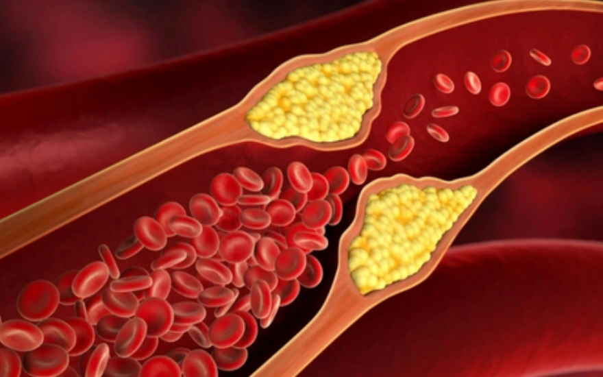 Cholesterol trong máu cao có thể dẫn đến nguy cơ xơ vữa động mạch