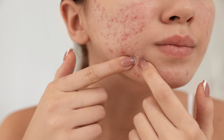 Tăng androgen có thể gây mụn trứng cá ở trẻ