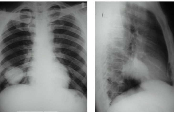 giảm đau ung thư