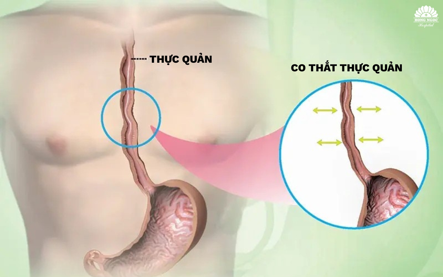 co thắt thực quản
