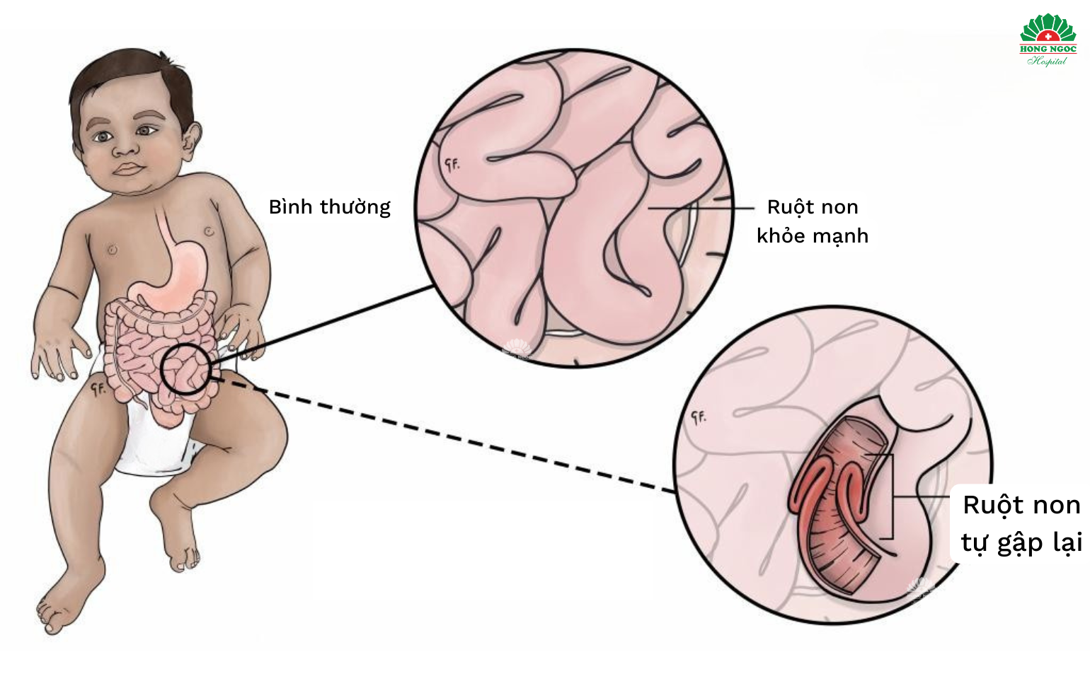 Lồng ruột ở trẻ em
