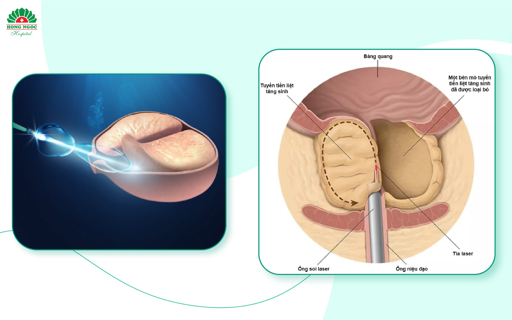 Phẫu thuật phì đại tiền liệt tuyến bằng laser