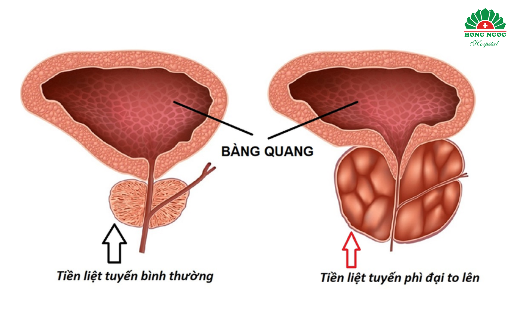 phì đại tiền liệt tuyến