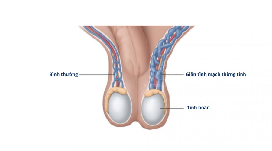 giãn tĩnh mạch thừng tinh