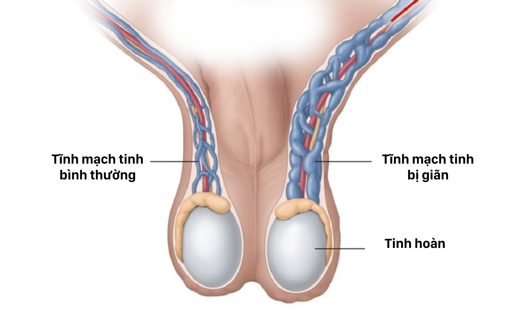 Giãn tĩnh mạch thừng tinh