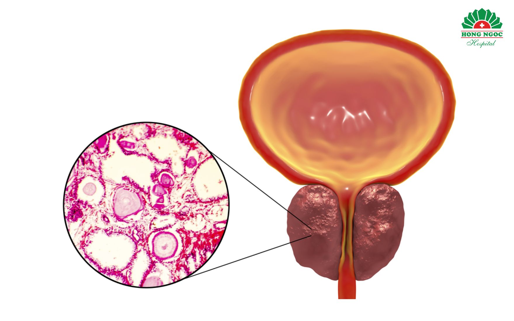 Điều trị phì đại tuyến tiền liệt không kịp thời và đúng cách có thể gây ra nhiều biến chứng nghiêm trọng