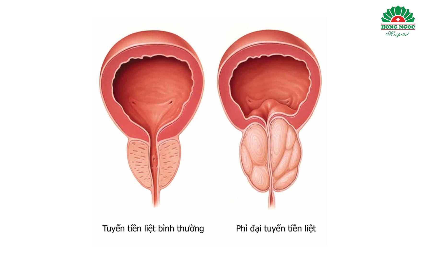 Phì đại tuyến tiền liệt có nguy hiểm không?