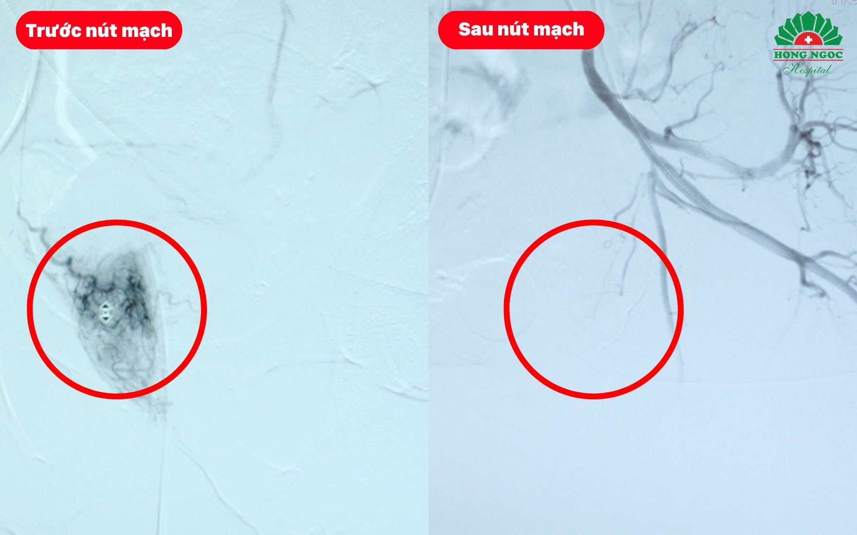 Phi Dai Tuyen Tien Liet Nut Mach 1