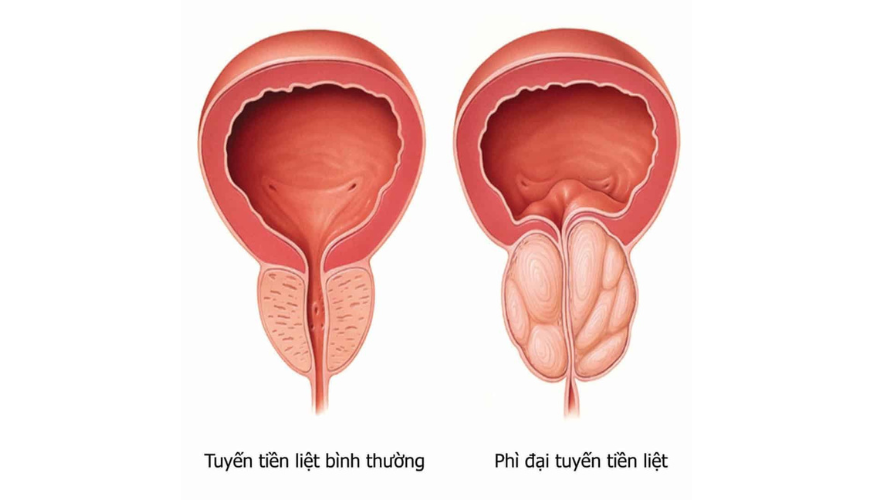 Phi Dai Tuyen Tien Liet