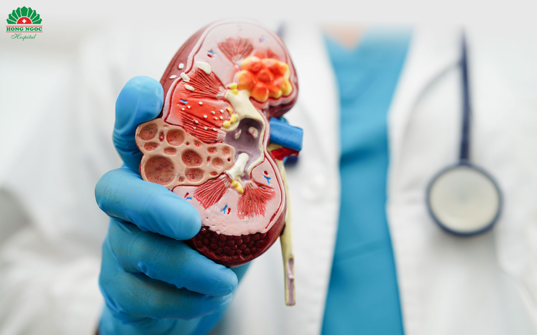 triệu chứng sỏi thận