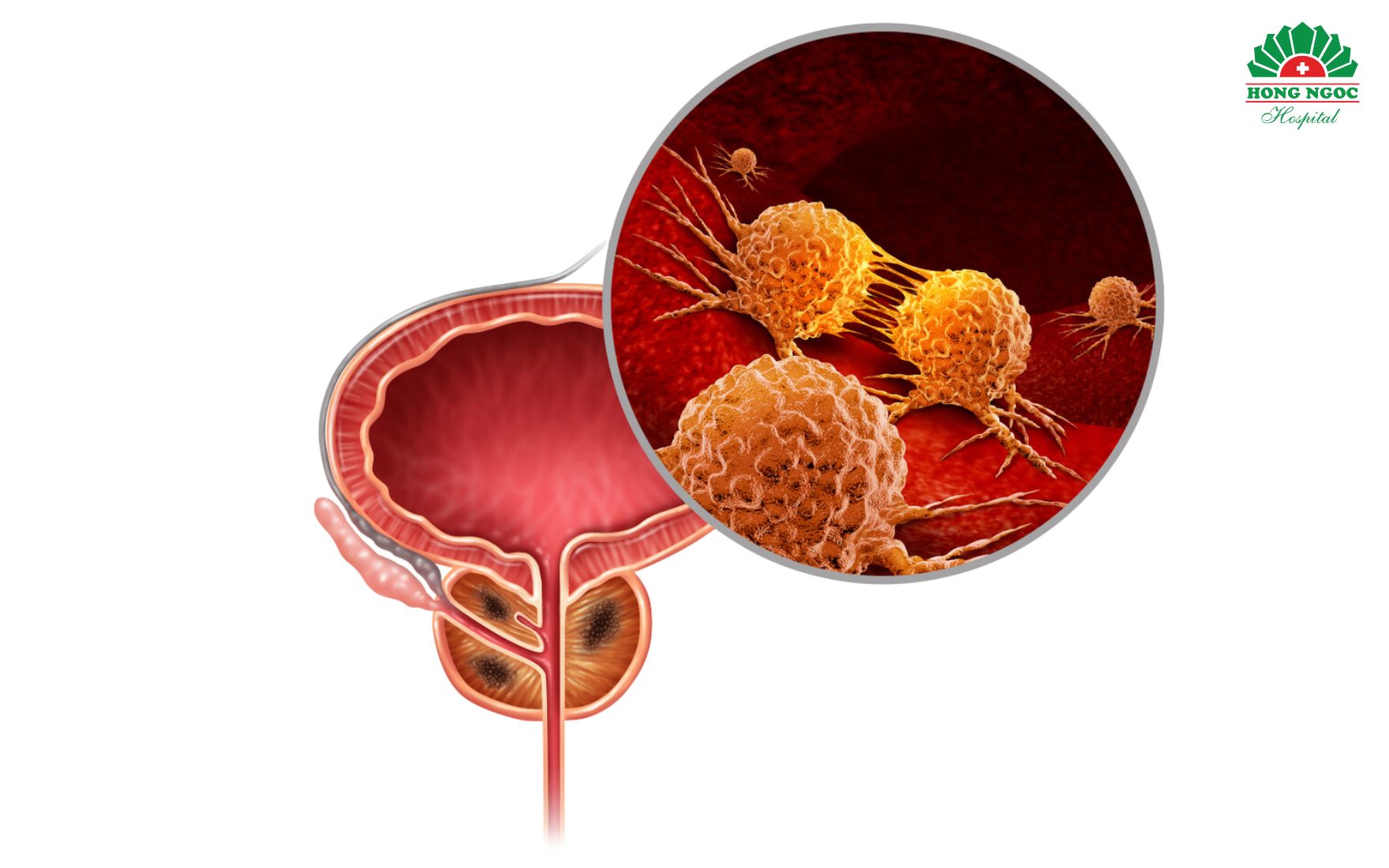 U tuyến tiền liệt là bệnh lý thường gặp ở nam giới trên 50 tuổi, gây nhiều phiền toái cho cuộc sống