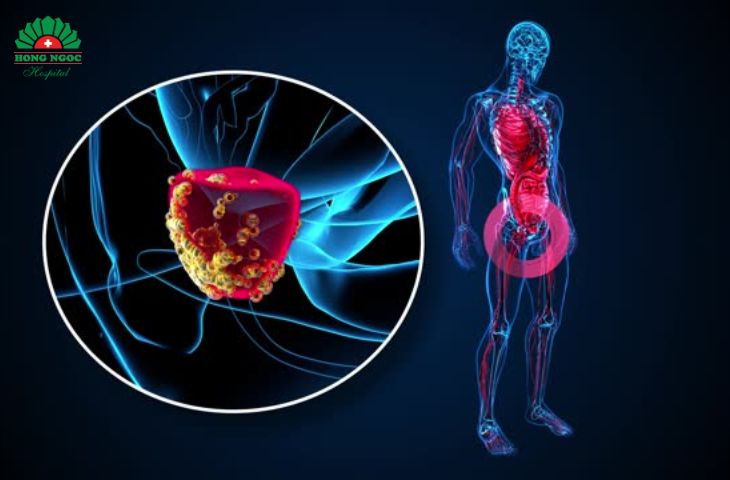 điều trị viêm tuyến tiền liệt 