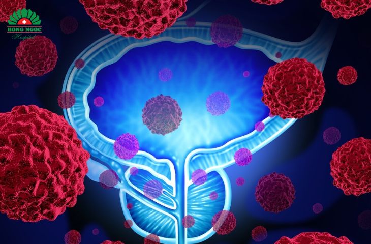 Viem Tuyen Tien Liet Man Tinh