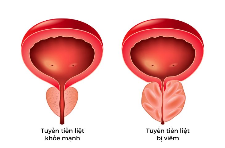 viêm tuyến tiền liệt