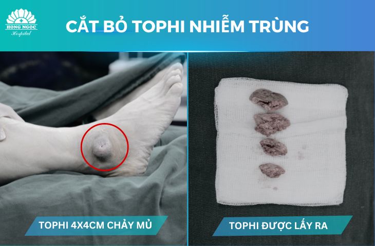 Mổ hạt tophi: Giải pháp hiệu quả điều trị biến chứng bệnh gout