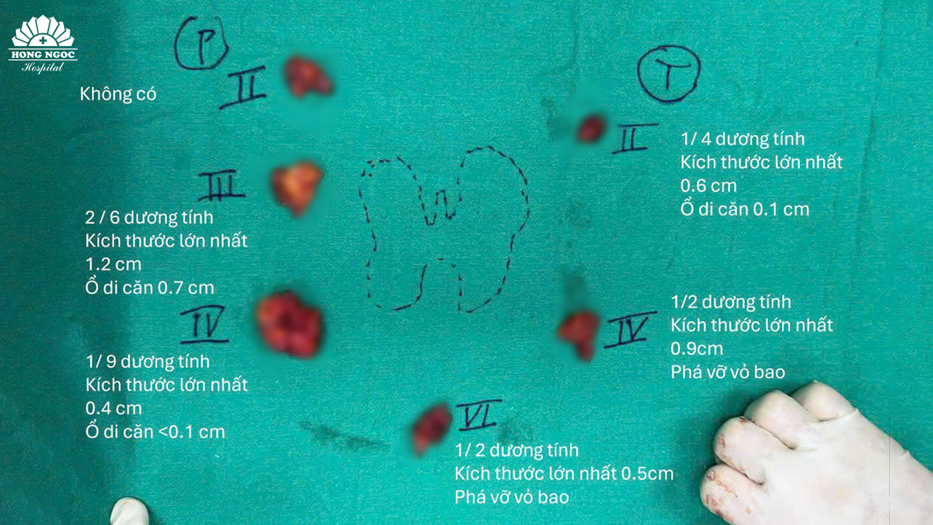 Nạo vét sạch hạch di căn theo bản đồ hạch lập trước mổ 