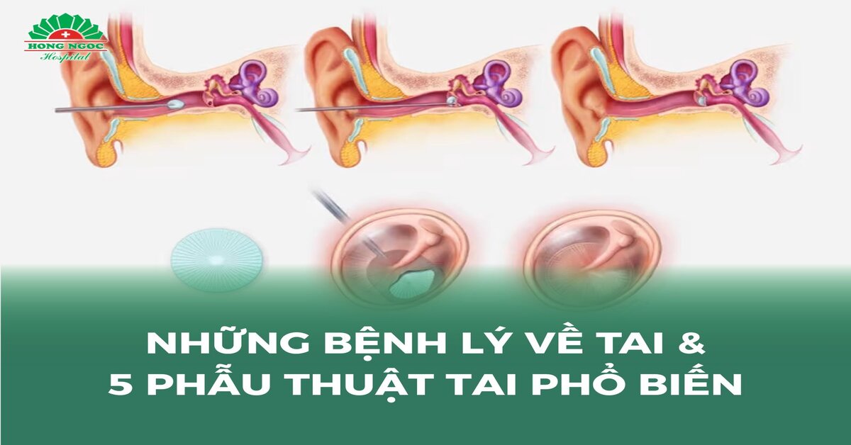 Những bệnh lý về tai thường gặp và 5 phẫu thuật tai phổ biến nhất