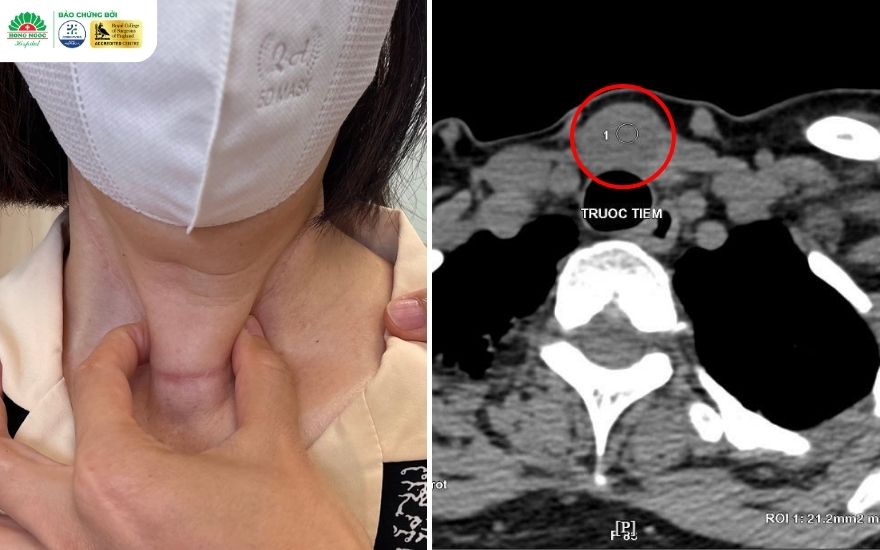 Khối hạch ung thư giáp tái phát hơn 3cm tại hố giáp trái