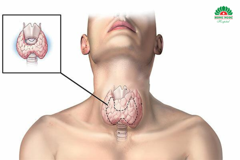 4. Phân loại u tuyến giáp