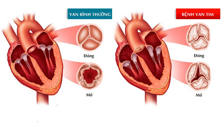 Tổng quan về bệnh van tim hậu thấp