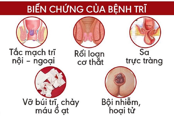 Hoại Tử Búi Trĩ: Nguyên Nhân, Triệu Chứng và Điều Trị Hiệu Quả