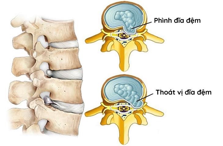 Các Biến Chứng Của Phình Đĩa Đệm