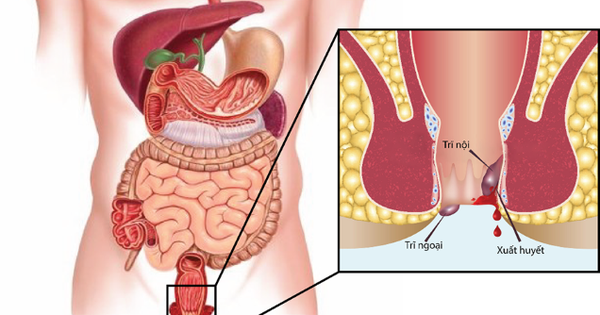 Trĩ Ngoại Điều Trị: Nguyên Nhân và Giải Pháp Hiệu Quả Cho Bệnh Trĩ Ngoại