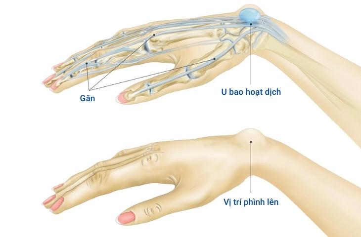 Cách phòng ngừa u xương cổ tay