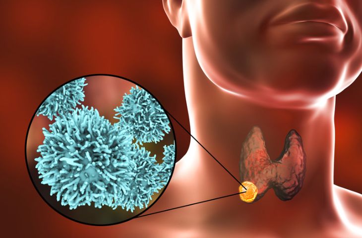 Phòng ngừa Carcinoma tuyến giáp dạng nhú