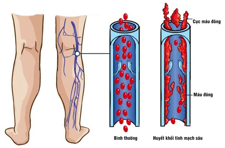 Huyết Khối Tĩnh Mạch Chi Dưới: Nguyên Nhân, Triệu Chứng và Cách Phòng Ngừa