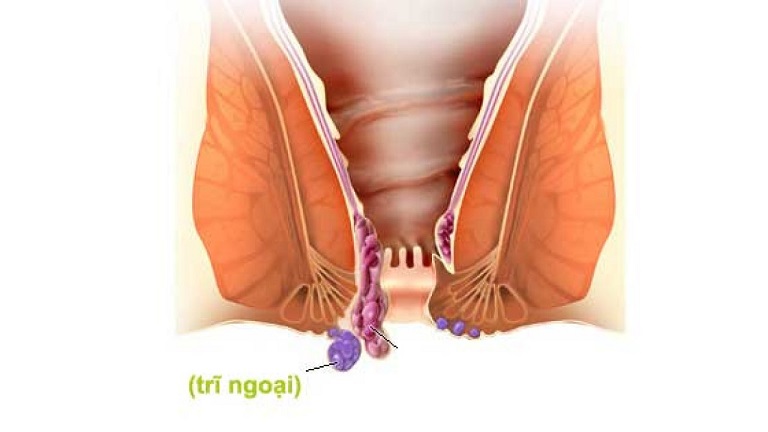 1. Nguyên nhân phổ biến gây bệnh trĩ ngoại