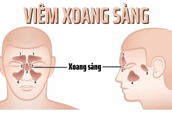 Bệnh Viêm Xoang Sàng: Triệu Chứng, Nguyên Nhân Và Phương Pháp Điều Trị Hiệu Quả