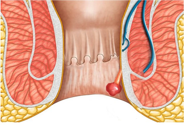 Polyp Hậu Môn: Nguyên Nhân, Dấu Hiệu và Phương Pháp Điều Trị Hiệu Quả